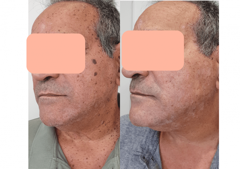 antes-despues-768x543