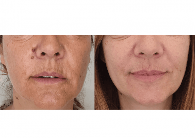 eliminacion-verrugas-laser-co2-1-1-768x543