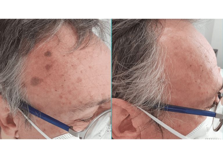 eliminacion-verrugas-laser-co2-1-7-768x543