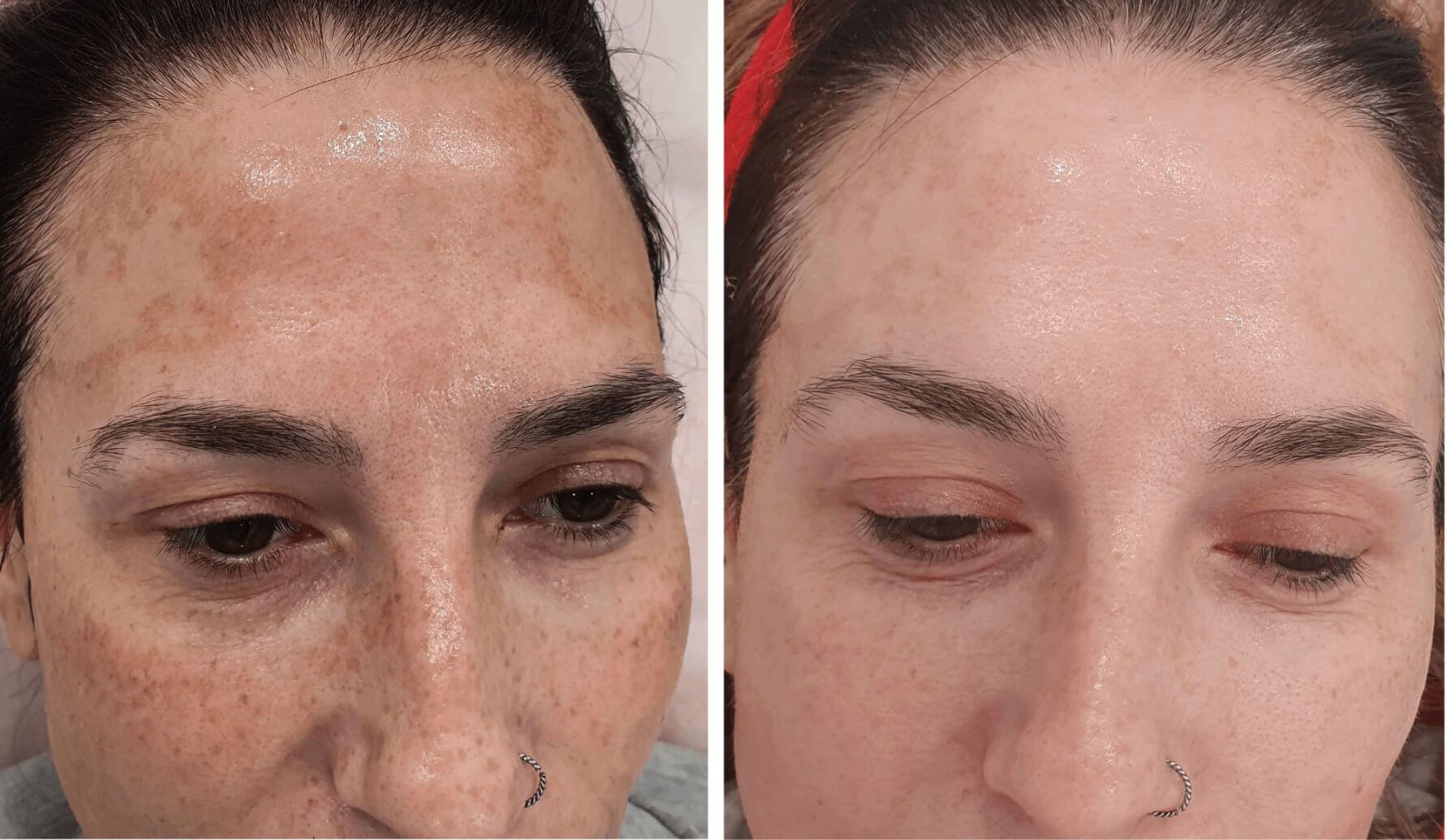 melasma-laserco-antes-despues-1