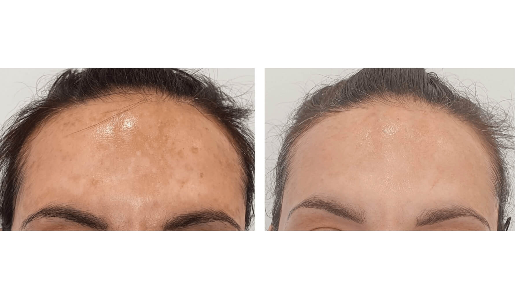 melasma-laserco-antes-despues-2