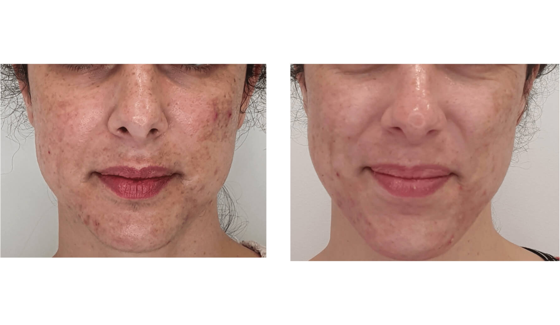 melasma-laserco-antes-despues-3