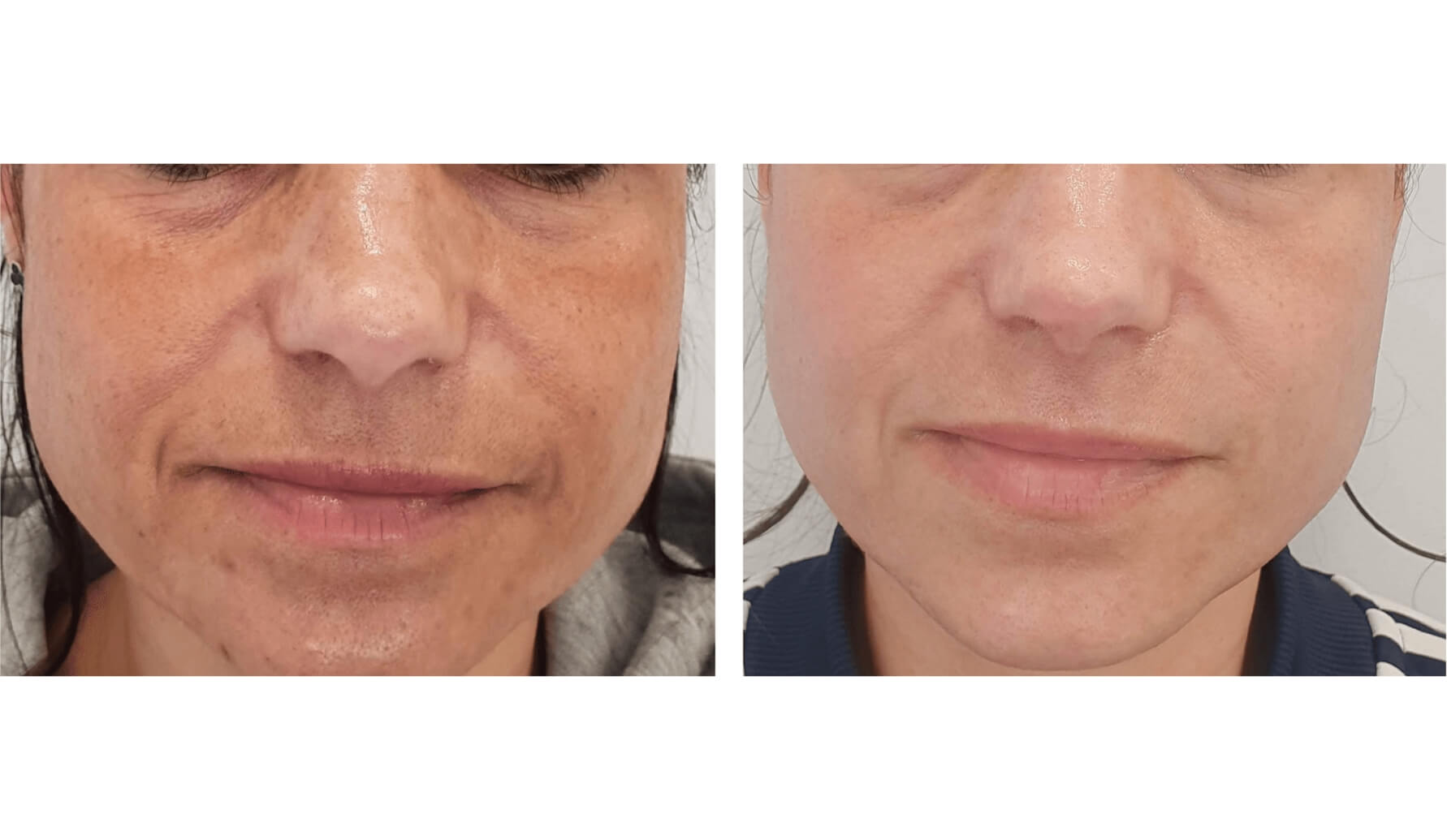melasma-laserco-antes-despues-4