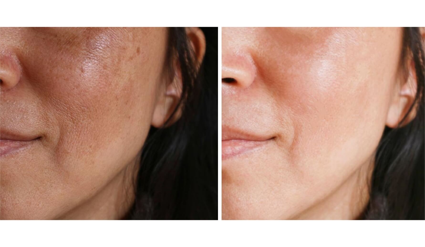 melasma-laserco-antes-despues-5