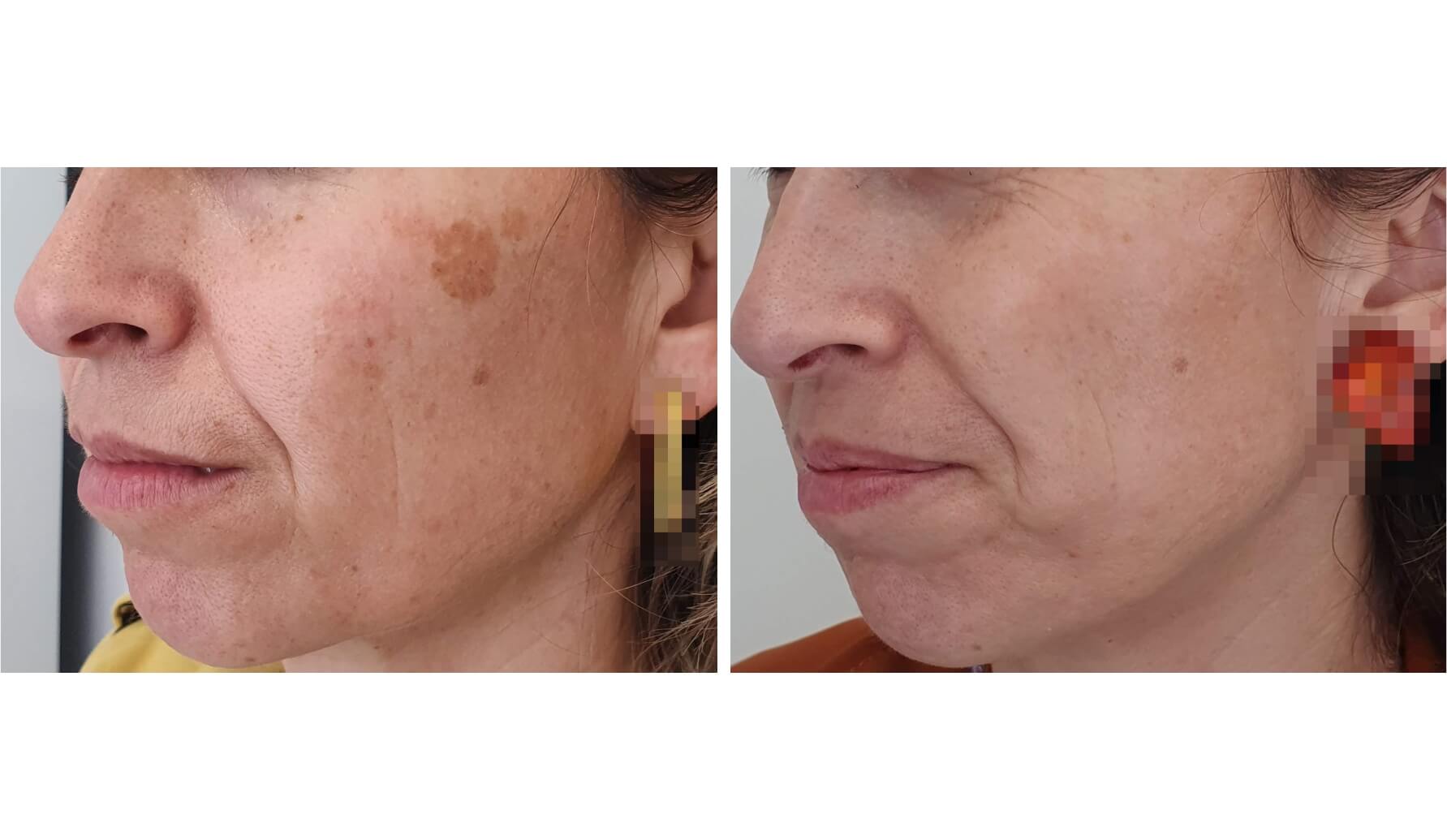 melasma-laserco-antes-despues-6