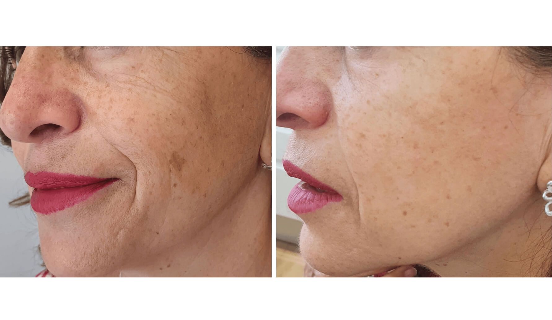 melasma-laserco-antes-despues-7