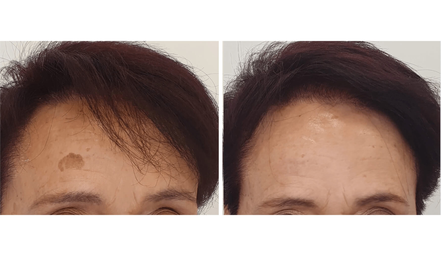 melasma-laserco-antes-despues-8