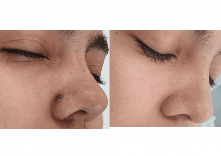 verrugas-lunares-laser-co2-1-768x543