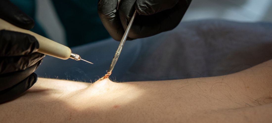 Qué es el condiloma y cómo tratarlo