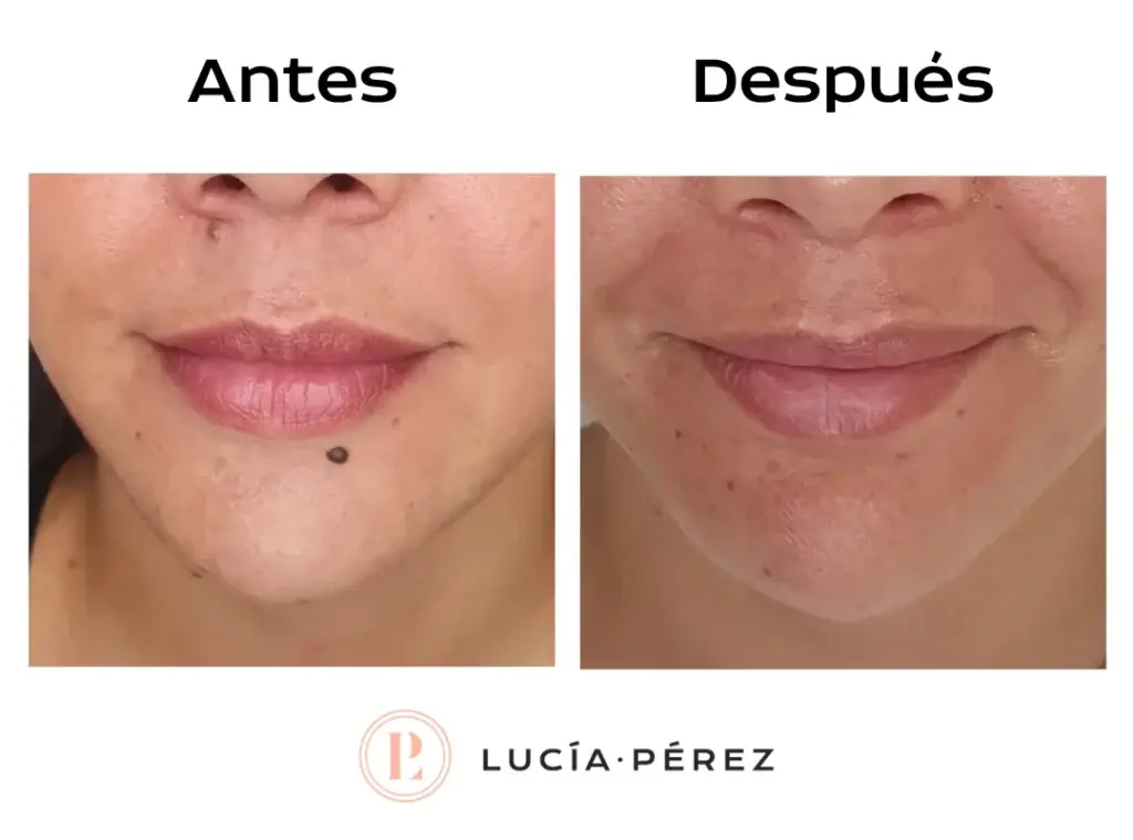 Antes y después del tratamiento de verrugas con dermatóloga en Alcalá de Henares