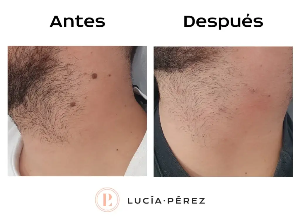Antes y después de quitar verrugas con tratamiento dermatológico