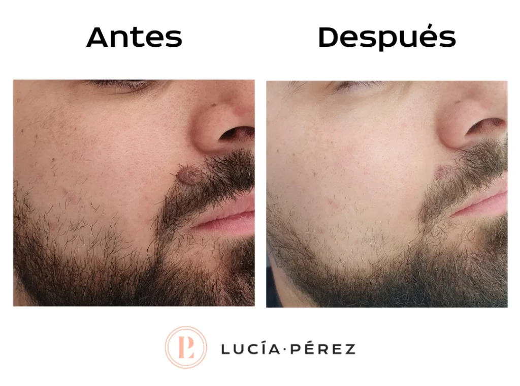 Eliminación de verrugas antes y después – Dra. Lucía Pérez Alcalá de Henares